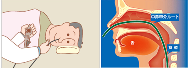 経鼻内視鏡